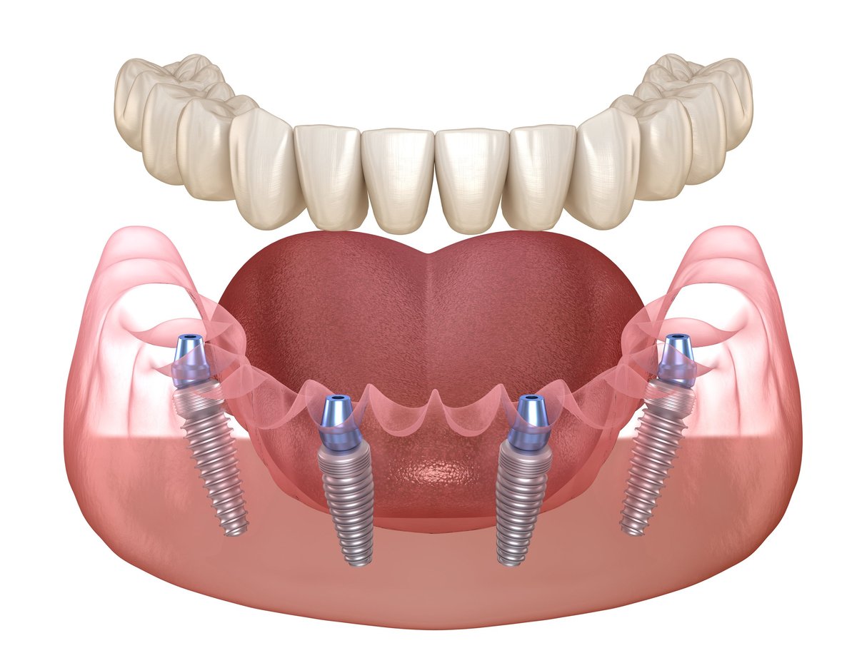 Mandibular prosthesis All on 4 system supported by implants. Medically accurate 3D illustration of human teeth and dentures concept