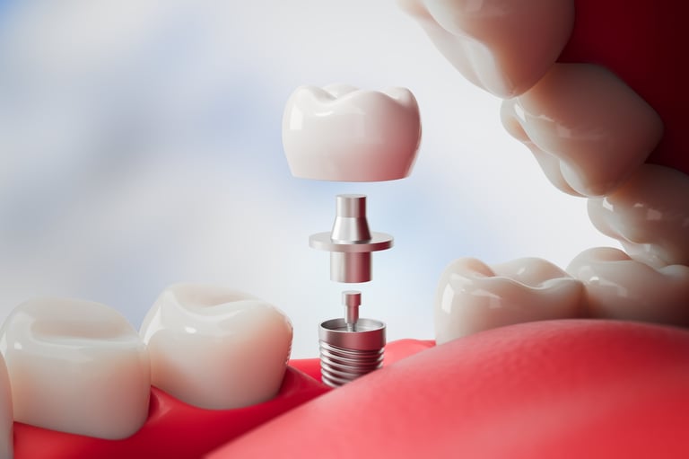 Dental implant parts including crown, abutment, and screw inside open mouth, realistic 3D Rendering on soft gradient background, concept of oral surgery