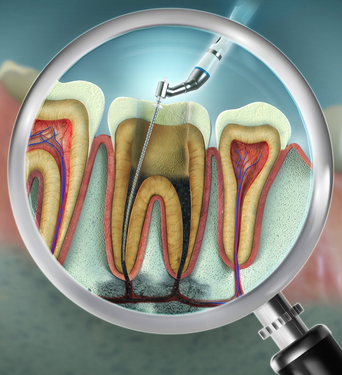 Advanced endodontic file in action removing infected enamel dentin and pulp tissue.